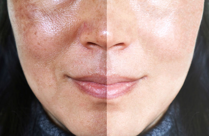 Hyperpigmentation And Its Treatment Modalities